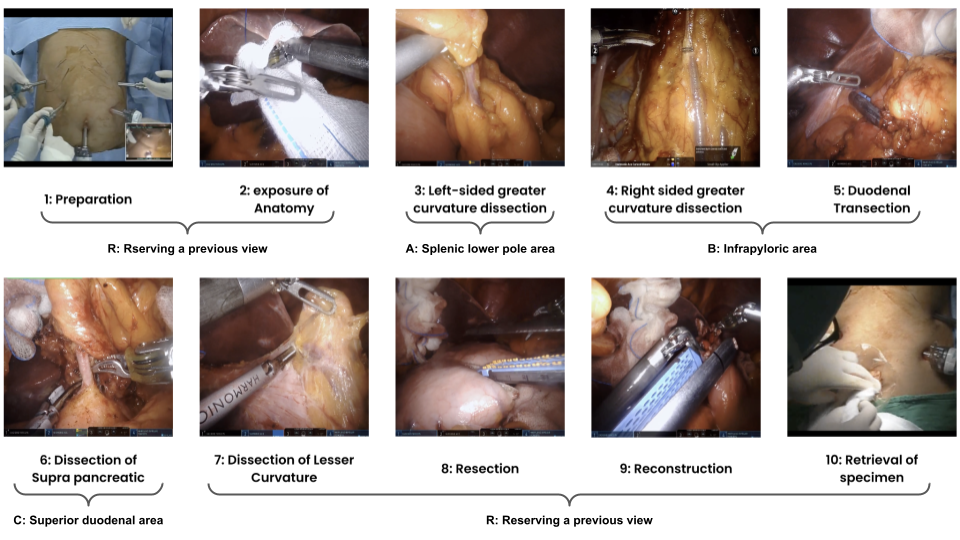 Surgical Phase Definitions